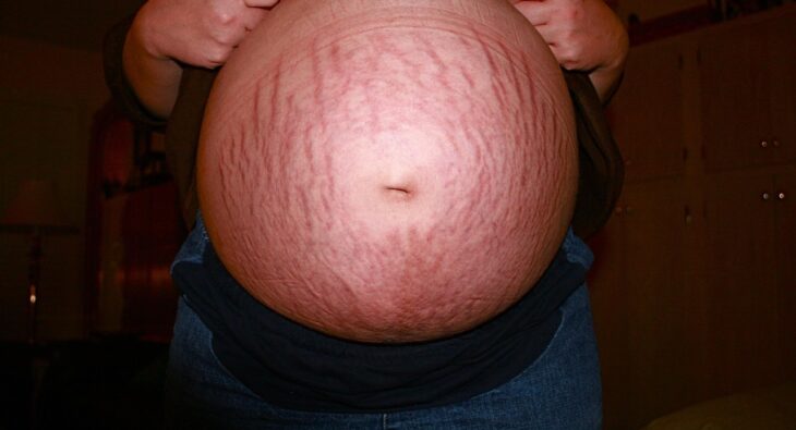 Najlepszy Balsam na Rozstępy w Ciąży – Poradnik 2026!